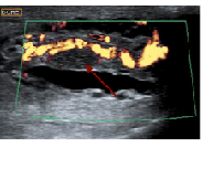 Vasitis Vs Incarcerated Inguinal Hernia: A Differential Diagnosis Challenge