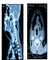 Gas Gangrene in the Neck Caused by an Odontogenic Infection- A Case Report