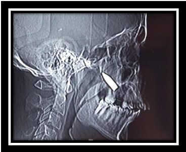 Maxillofacial Gunshot Injury in Experience of Iraqi War Against Terrorism