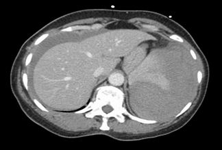 Splenic Rupture Following Colonoscopy: Case Report