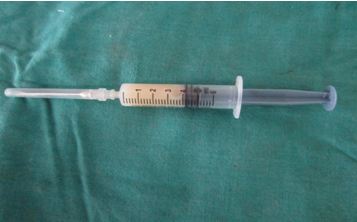 Modified Carnoy’s Solution Use in Keratocystic Odontogenic Tumour - A Case Report