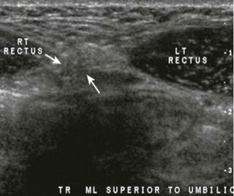 Versatility of Ultra Sound Scan in Paediatric Epigastric Hernia Repair