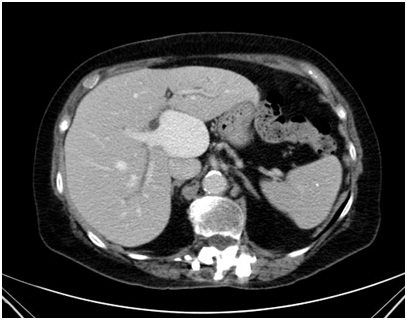 Giant Portal Vein Extra Hepatic Aneurysm: An Uncommon Finding