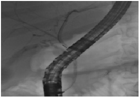 Case Report of Chronic Pancreatitis in aPatient with Celiac Disease and Extra-Intestinal Manifestations of Celiac Disease: Report of a Case and a Literature Review