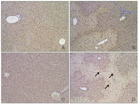 Monocyte-Derived Macrophages Exacerbate Acetaminophen- Induced Liver Injury in Mice through Intrahepatic Hypercoagulation