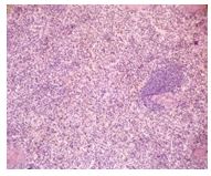 Autoimmune Hemolytic Anemia in Ulcerative Colitis