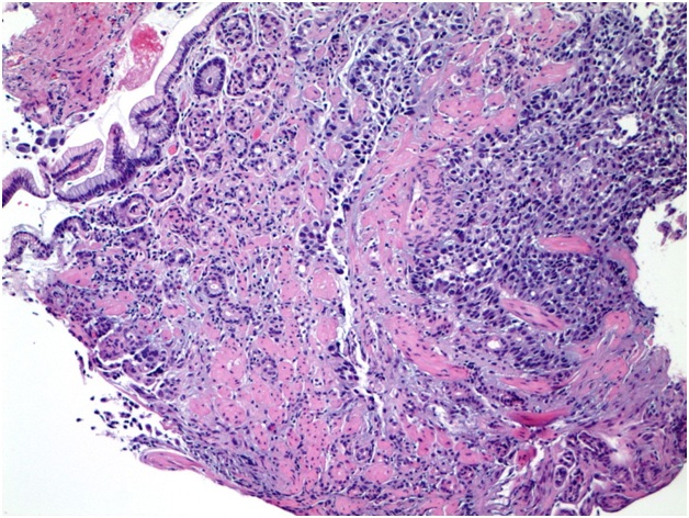 Acinar Cell Carcinoma of the Pancreas with Gastric Metastasis: A Case Report and Literature Review