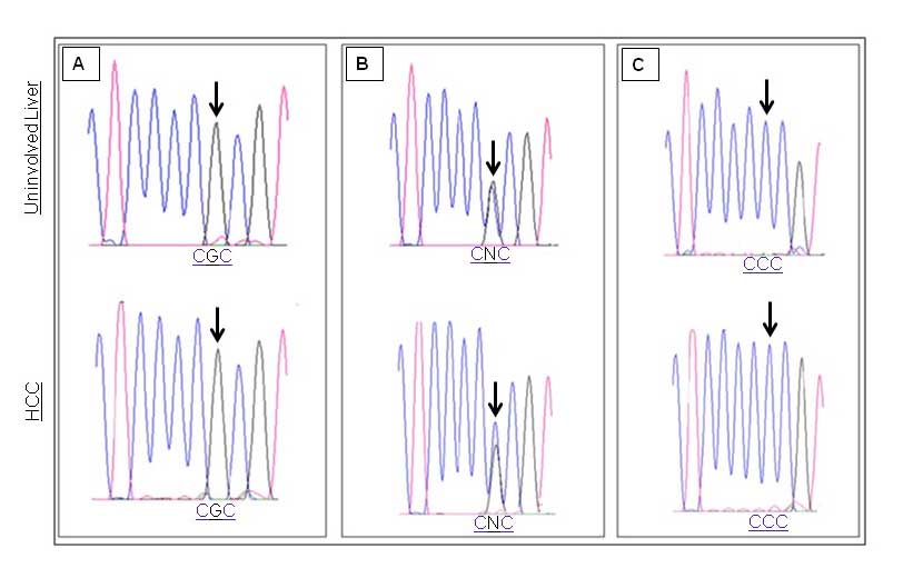 Association between Hepatitis C Virus Infection, P53 Phenotypes, and Gene Variants of Adenomatous Polyposis Coli in Hepatocellular Carcinomas