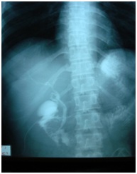 Management of Postoperative Bile Leak, Tertiary Centers Experience