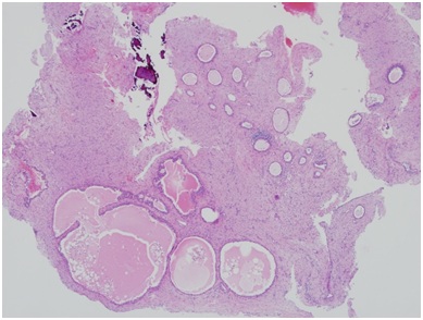 A Case of Chronic Otitis Media Surgery in an AIDS Patient