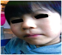 A Case of Atopic Dermatitis That Healed Virtually Completely After A Number of Intradermal Injections with A Non-Specific Antigen Solution