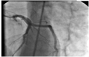 Coronary Aneurysm and Myocardial Infarction in Young Adult Secondary to Undiagnosed Childhood Kawasaki Disease