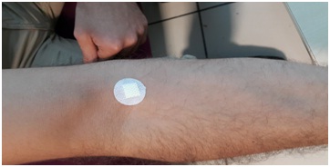The Effects of Classic Two-Minute Pressing and Commercial Adhesive Bandages on Ecchymosis Development Following Removal of Intravenous Catheters