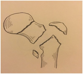 Hemiarthroplasty (HA) with a Two-Step Osteotomy in Unstable Intertrochanteric Osteoporotic Fractures of Senile Patients (A Report of 65 Cases)