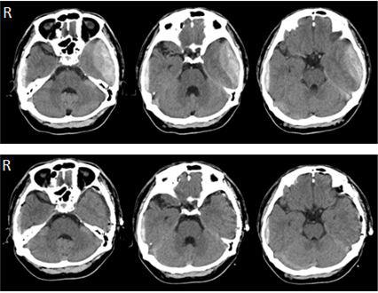 Bilateral Acute Traumatic Epidural Hematoma Due to Coup and Contrecoup Head Injury: a Case Report and Review of the Literature