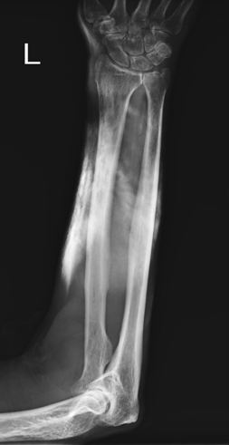 Forearm Extravasation Injury in the Emergency Department