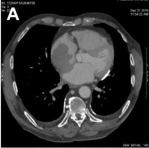 Recurrence of Testicular Large B-Cell Non-Hodgkinâ€™s Lymphoma Presenting as Right Atrium Mass: A Case Report