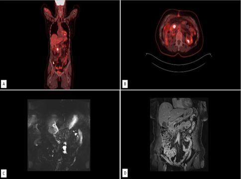 Metastatic Pancreatic Adenocarcinoma Presenting as Primary Ureteral Tumor