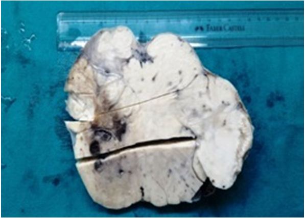 High Grade Primary Intratesticular Leiomyosarcoma: A Very Rare Presentation