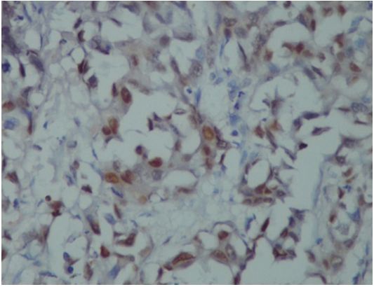 Expression of Telomerase in Breast Cancer and its Correlation with Clinicopathological Parameters