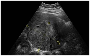 Uterine Myxoid Leiomyosarcoma Associated with Multiple Myomata in a Fertile Woman: A Case Report