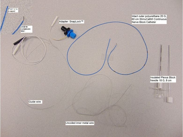 An Unusual Shearing Of the Internal Coil of a Stimulating Peripheral Nerve Block Catheter
