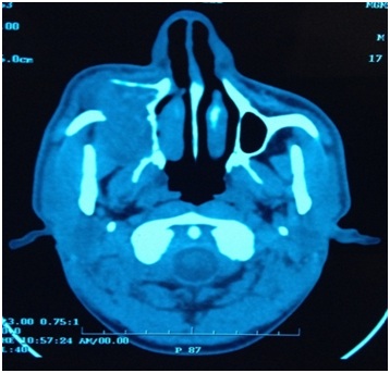 Giant Idiopathic Mucopyocele of Maxillary Sinus Presenting as Asymptomatic Unilateral Facial Swelling: A Case Report