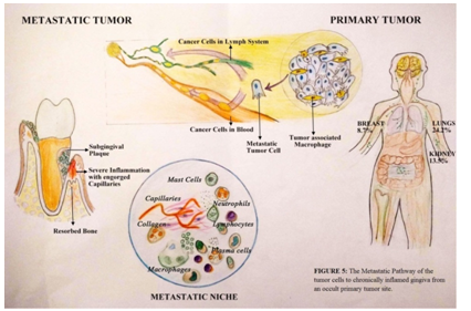 Metastasis of Adenocarcinoma to the Gingiva: A Rare Case Report