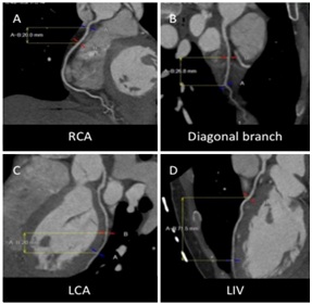 Combination of Sickle Cell and Alpha-Thalassemia Traits and Incidence of Non-Atherosclerotic Myocardial Infarction in a Young Woman, Beyond Coincidence?