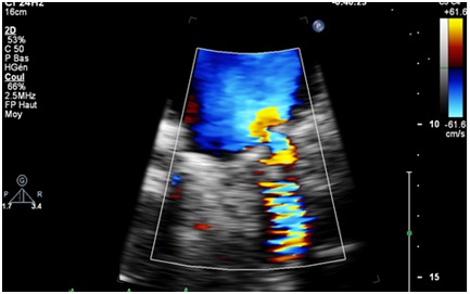 The Contribution of Echocardiography in the Dysfunctions of Mechanical Prosthesis: Report of 11 Cases