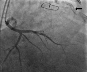 Densely Calcified Polytetrafluoroethylene Right Ventricular out flow tract patch explanted after 33 years