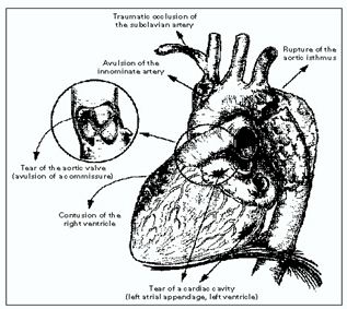 Trauma of the Heart and Great Vessels