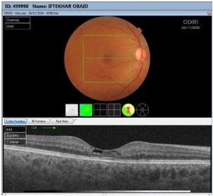 The Use of Swept Source Oct Angioin Diagnosis andStaging of Type 2 Macular Telangictasia (Mactel 2)