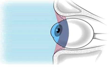 Ocular Damage after Peri-orbital Alexandrite Laser Treatment of Cutaneous Vascular Tumors