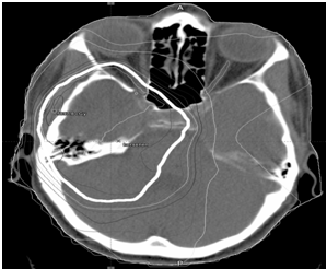 Optic Nerve and Chiasma Glioma Versus Radiation-Induced Chiasma Injury: is the Diagnosis Really that Easy?