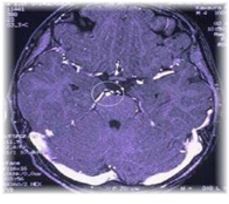 Ophthalmoplegic Migraine: A Single Dose of Predonisolone at the onset Can Shorten the Duration of Headache and Prevent the Ophtalmoplegia