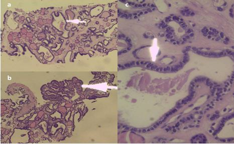 Thyroid Follicular Carcinoma with Mediastinal Cervical Metastasis and Papillary Pattern Presence: A Rare Phenomenon