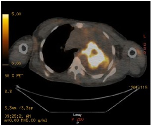 A Case of Primary Pulmonary Malignant Peripheral Nerve Sheath Tumor in a Patient with Neurofibromatosis