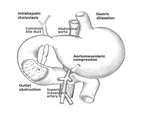 Intrahepatic Cholestasis Complicating Superior Mesenteric Artery Syndrome