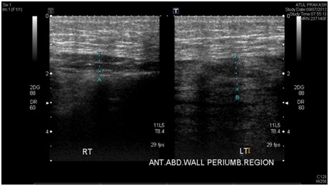 Acute Phlegmonous Gastritis with Pangastric Necrosis-a Perplexing Presentation in a Young Male with Pyrexia of Unknown Origin
