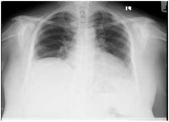 Idiopathic Right Diaphragm Paralysis