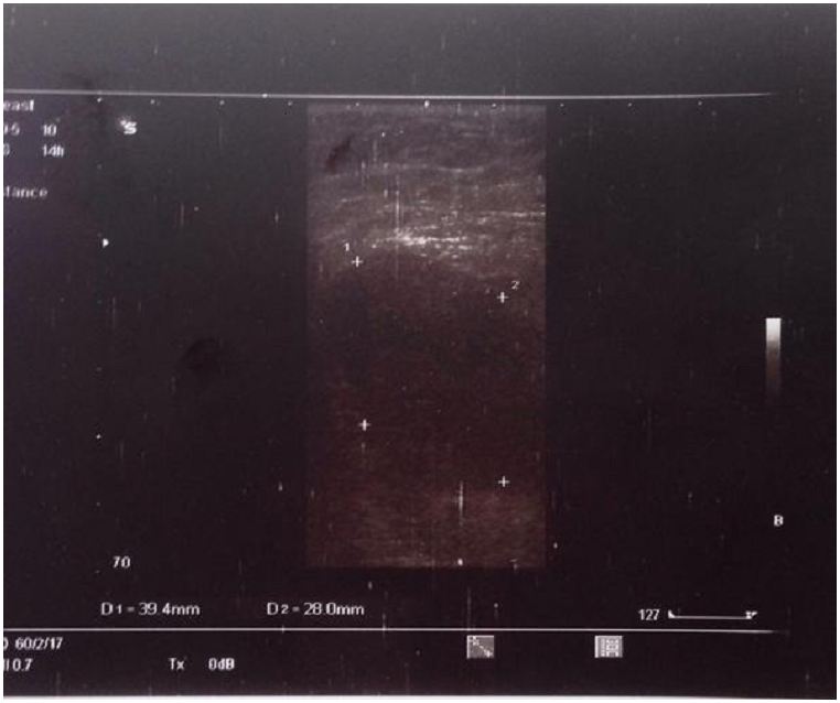 Metastatic Signet-Ring Cell Cecum Cancer to Breast