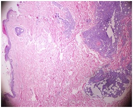 A Rare Follicular Lymphoma Case: Relapsed with Skin Involvement
