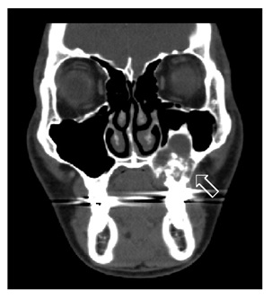 Maxillary Ameloblastoma: A Pictorial Case Report