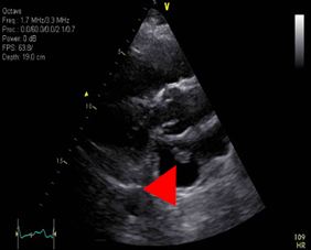 Extensive Pulmonary Embolism with Patent Foramen Ovale: Unique Presentation Highlights Importance of Multidisciplinary Management Strategies