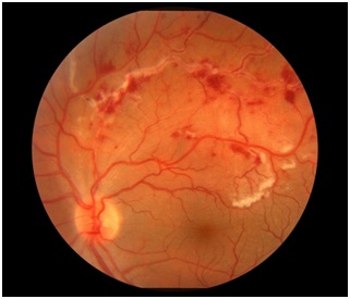 Proper Diagnosis for a Proper Management of Retinal Vasculitis