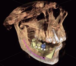 The Concept of Computer Assisted Implantology: The Accuracy Outcomes