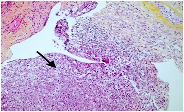 Diagnosis and treatmentstrategies for primarytesticularlymphomain patients withmonorchidism: A case report