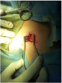 Dormant and Subclinical Bacterial Infections of Brain May Be the Cause behind All Epilepsies Including That Due To Post-Traumatic or Associated with Space Occupying Lesion SOL