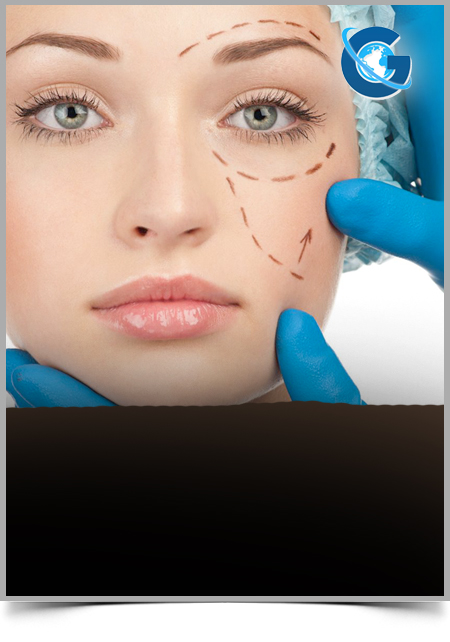 Skin Facelift with Supra-SMAS Plication